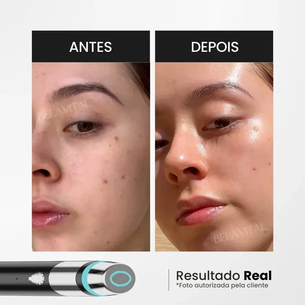 AGE-A Booster Dispositivo Coreano Facial