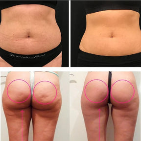 LipoPower - Redutor de Gordura e Celulite sem Cortes