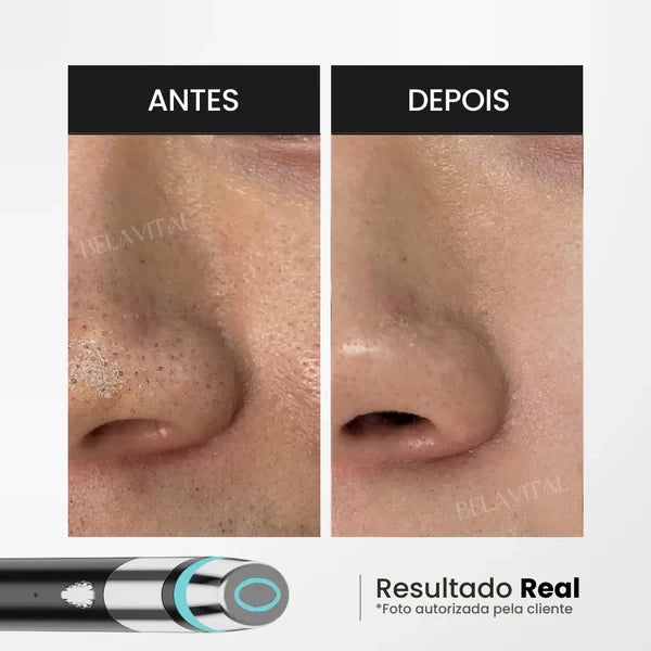 AGE-A Booster Dispositivo Coreano Facial