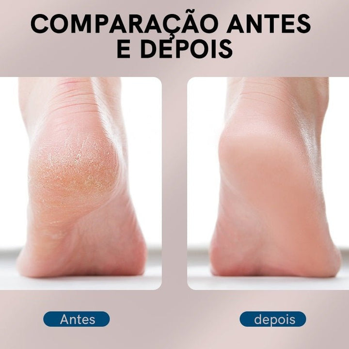 EasyClean - Lixa Removedora de Calos Elétrica Profissional Portátil loja deepbel